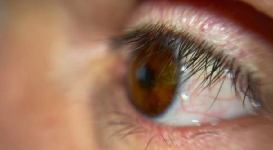 Patient Receives First 3D Printed Prosthetic Eye