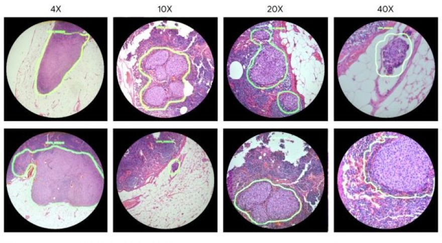 Google Builds Augmented Reality Microscope to Detect Cancer