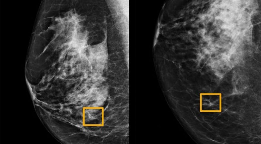 Google AI Is Better At Identifying Breast Cancer Than Human Doctors